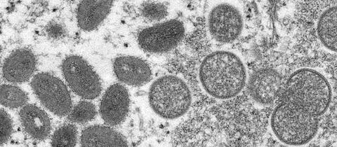Affenpocken-Virus unter dem Mikroskop