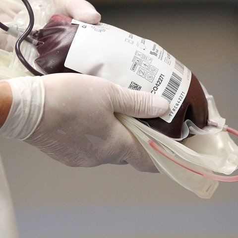 Hände, mit medizinischen Handschuhen bekleide,t halten einen Blutspende-Beutel mit Blut gefüllt.