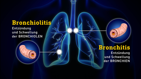 Grafik zu Bronchiolitis
